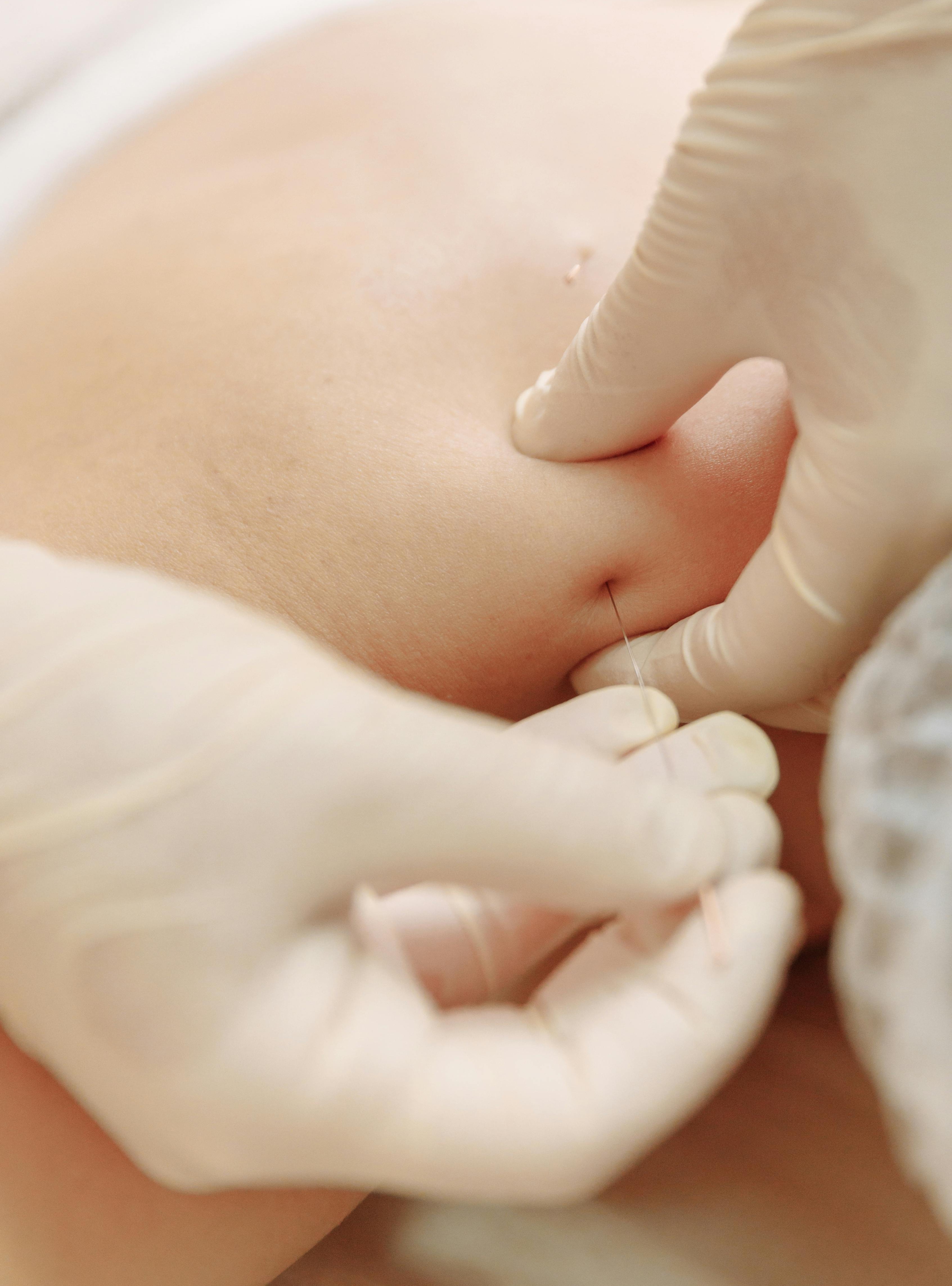 dry needling physical therapy